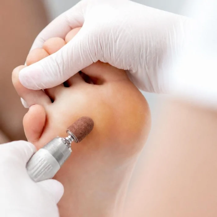Come rimuovere i calli dai piedi con e senza sgorbia pedicure