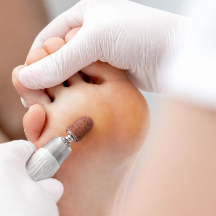 Come rimuovere i calli dai piedi con e senza sgorbia pedicure