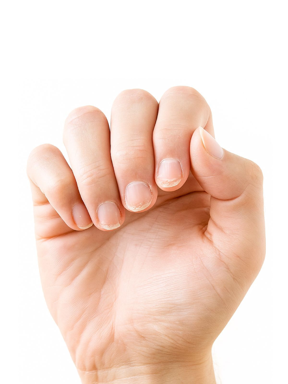 ongles abimes