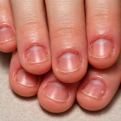 onychophagie ongles
