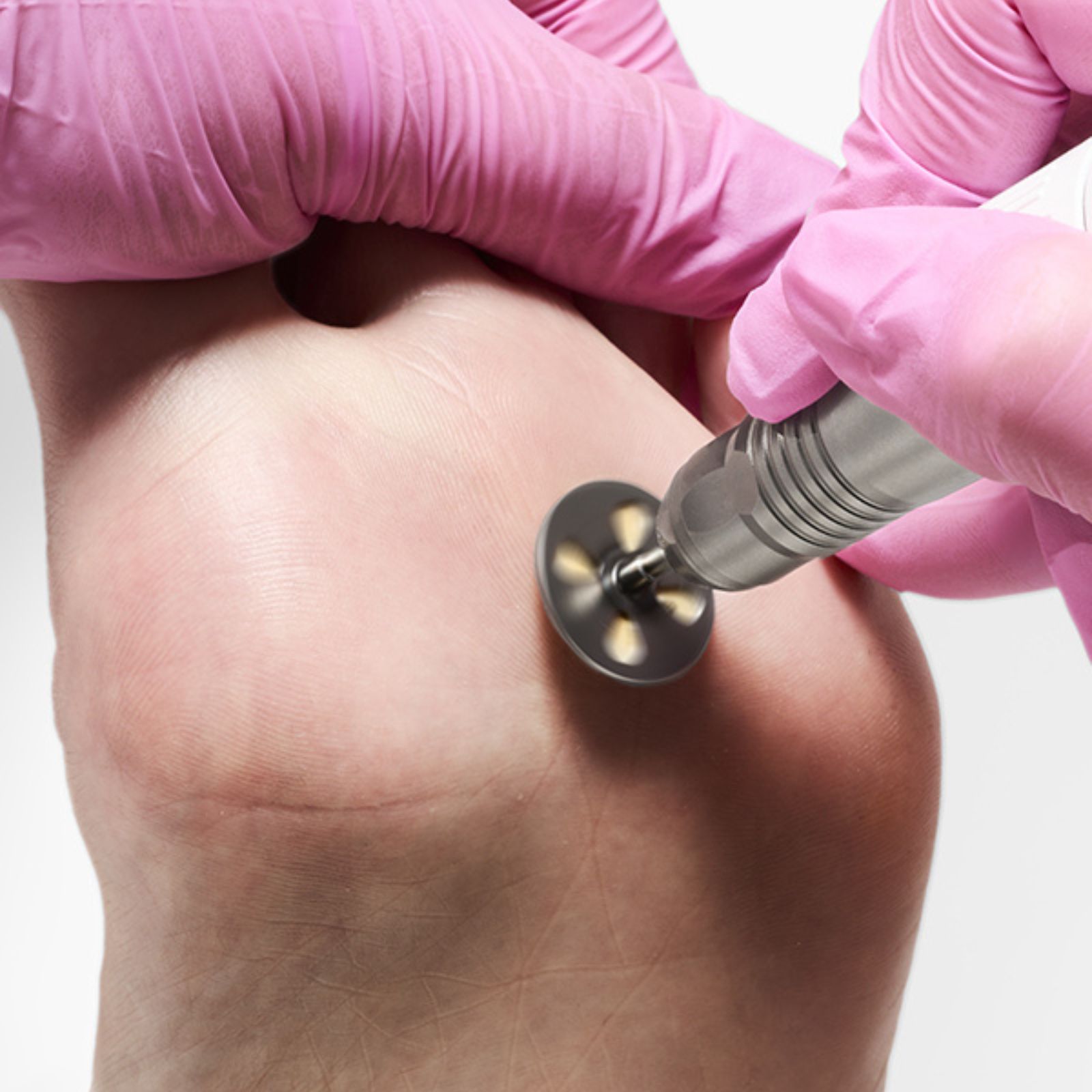 esfoliazione pedicure calli